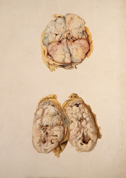 Two diseased parts of the body. Creator: Unknown.