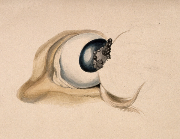 A diseased eye. Creator: Unknown.