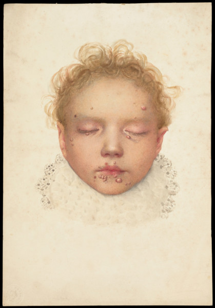 Head of a child with closed eyes and skin disease on the face, 1892. Creator: Unknown.