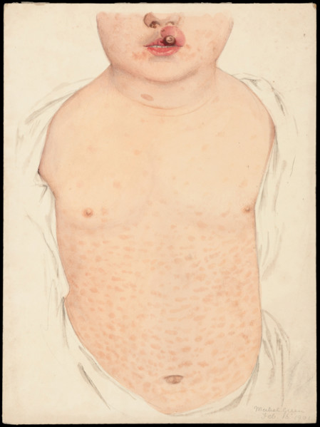 A boy with a congenital deformity of the mouth and a rash on the trunk, Feb 16th 1901. Creator: Mabel Green.
