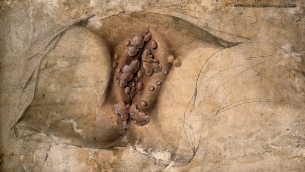 Female genitalia covered with syphilitic warts, c1824. Creator: Unknown.