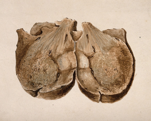 Section through polypus uteri, 1831. Creator: Unknown.