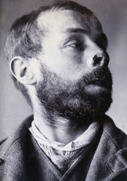 Friern Hospital, London: a man's face showing tuberculosis of the skin (lupus vulgaris), 1890/1910. Creator: Unknown.