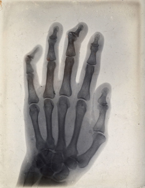 The bones of a hand, viewed through x-ray, 1895.