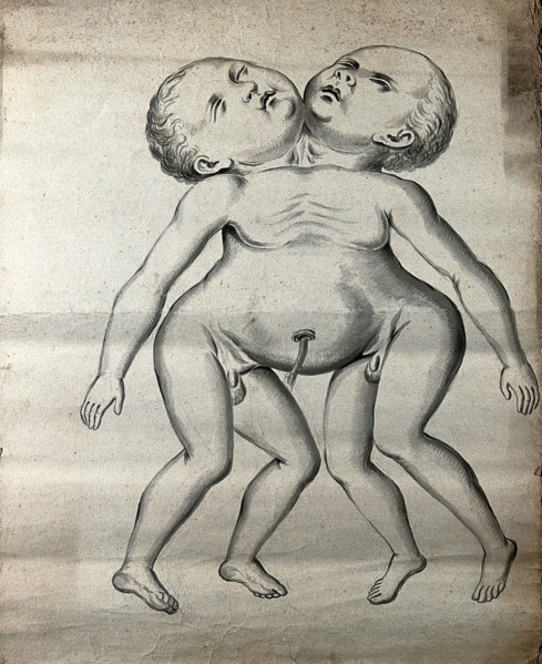 Male conjoined twins joined at the neck and chest; anterior view, 1900. Creator: Unknown.