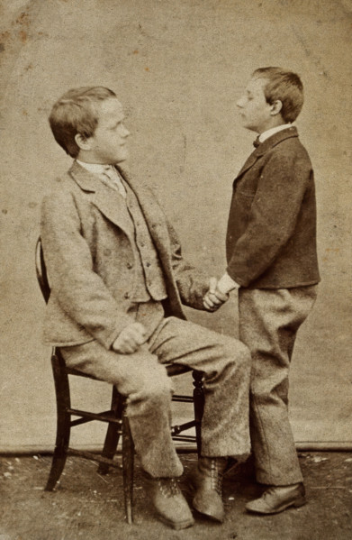 Down's syndrome: in two young men holding hands, one sitting and one standing, c1880s. Creator: Unknown.