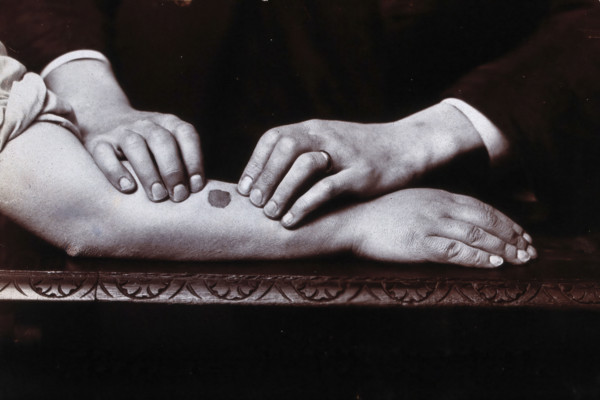 Two hands held on either side of a dark mark on a forearm, to demonstrate...., c1920s. Creator: Unknown.