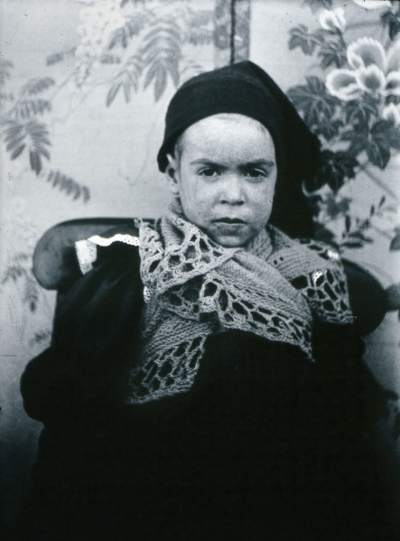 Gloucester smallpox epidemic, 1896: a child of the Beard family, as a convalescent smallpox..., 1896 Creators: HCF of Gloucester, Unknown.