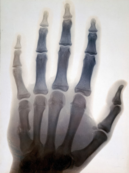Sir Gervas Powell Glyn, 6th Bart: radiograph of his hand, 1896. Creator: Sir GP Glyn.