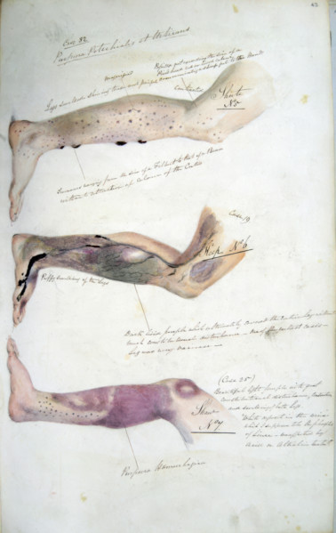 The effects of scurvy, February 1841. Creator: Henry Walsh Mahon.