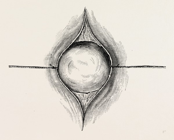 mode of exposing a tumour by ligature or threat retractors, medical equipment, surgical instrument,