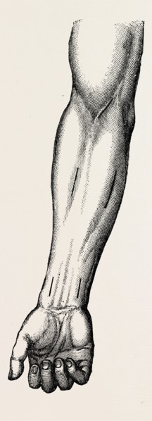 ligature, medical equipment, surgical instrument, history of medicine