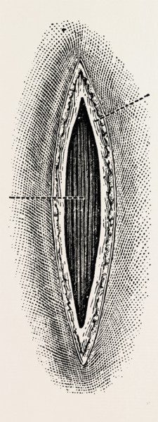 ligatuite of the right radial, medical equipment, surgical instrument, history of medicine
