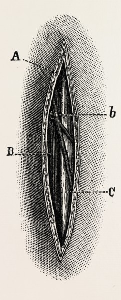 ligature, medical equipment, surgical instrument, history of medicine