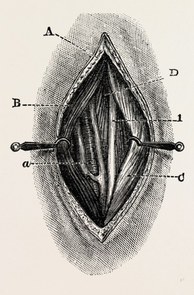 ligature, medical equipment, surgical instrument, history of medicine