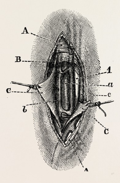ligature, medical equipment, surgical instrument, history of medicine