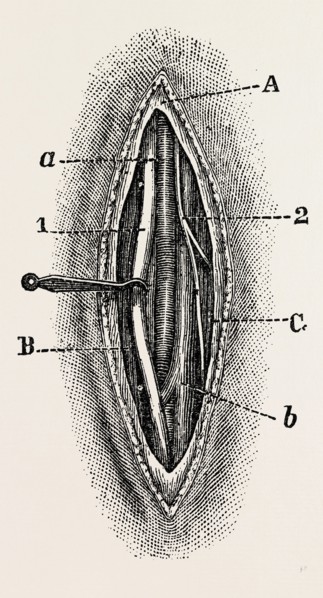 ligature, medical equipment, surgical instrument, history of medicine
