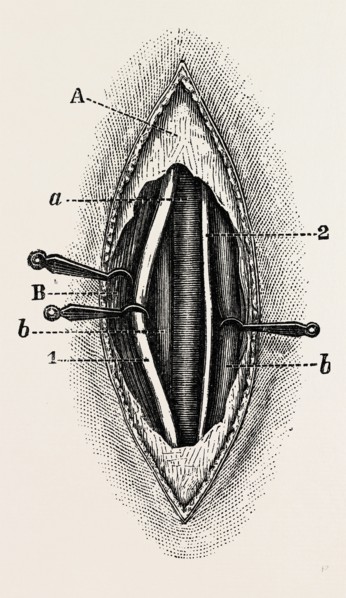 ligature of the right finger, medical equipment, surgical instrument, history of medicine