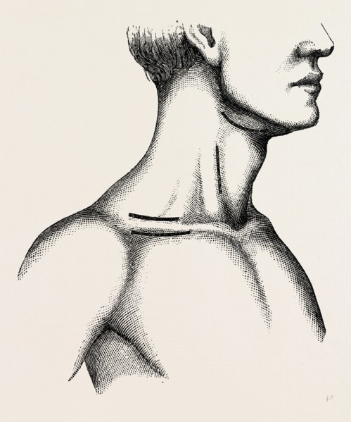 ligature of the first part, medical equipment, surgical instrument, history of medicine