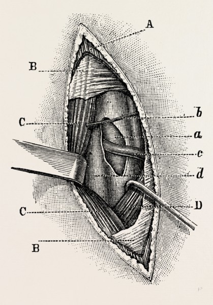 ligature, medical equipment, surgical instrument, history of medicine