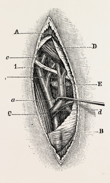 ligature, medical equipment, surgical instrument, history of medicine