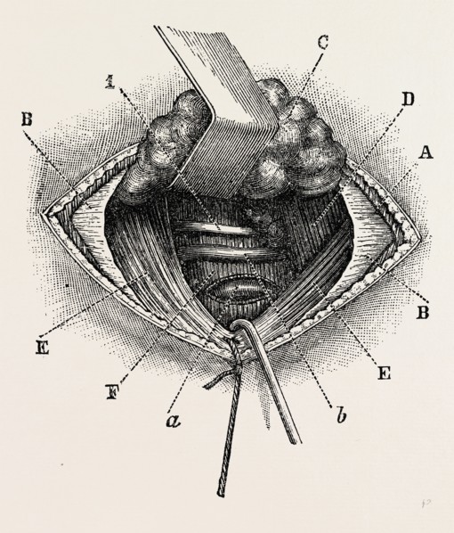 ligature of right lingual artery, medical equipment, surgical instrument, history of medicine