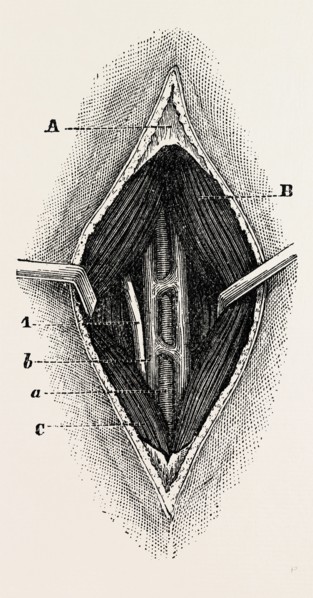tractor, the outer border of the ligature, medical equipment, surgical instrument, history of