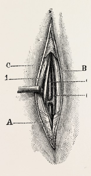 ligature, medical equipment, surgical instrument, history of medicine