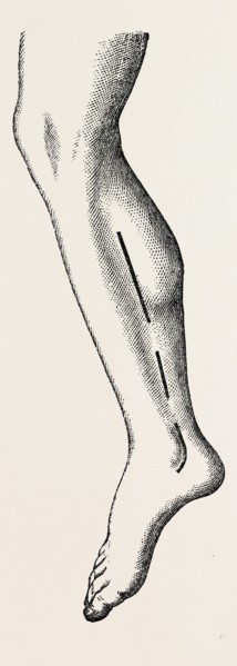 ligature, medical equipment, surgical instrument, history of medicine