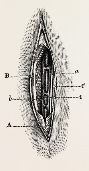 ligature, medical equipment, surgical instrument, history of medicine