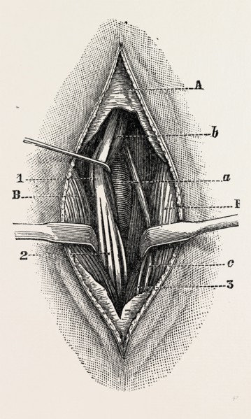 ligature, medical equipment, surgical instrument, history of medicine