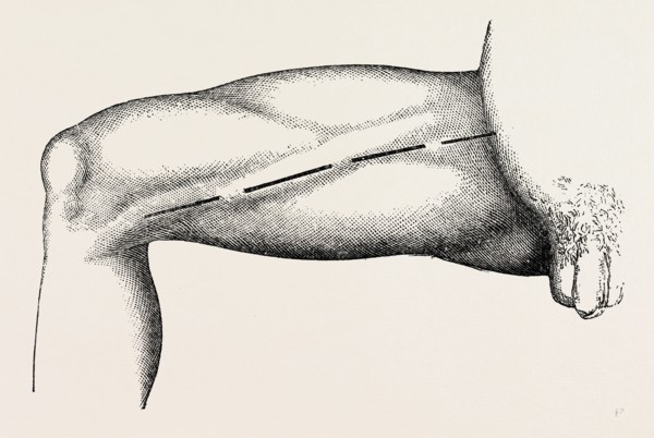 ligature of the right common femoral at the base of scarpa's, medical equipment, surgical
