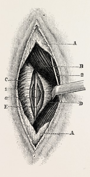 ligature, medical equipment, surgical instrument, history of medicine
