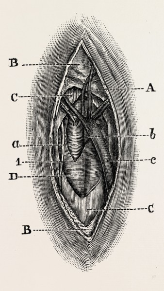ligature, medical equipment, surgical instrument, history of medicine