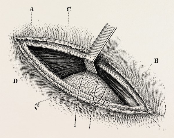 ligature of right external iliac artery, medical equipment, surgical instrument, history of