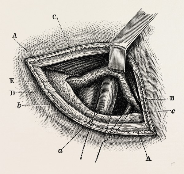 ligature of right external iliac artery, medical equipment, surgical instrument, history of