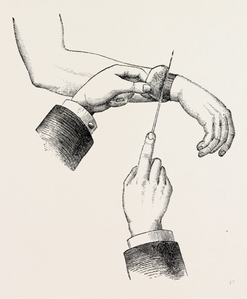 circular amputation de la manchette, medical equipment, surgical instrument, history of medicine