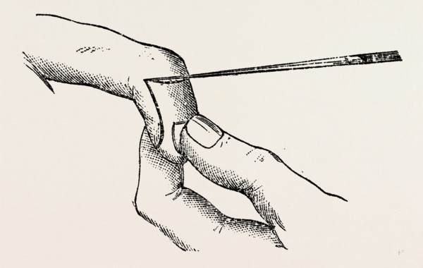 four inches long, a fine key, the mode of holding, medical equipment, surgical instrument, history