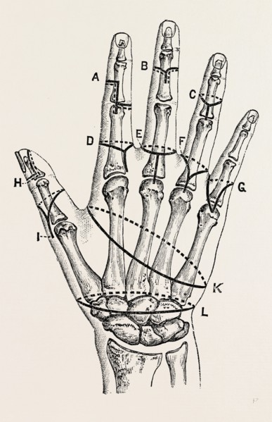 disarticulation by single external, medical equipment, surgical instrument, history of medicine