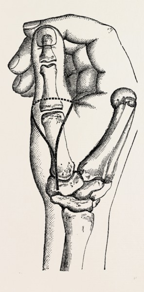 disarticulation, medical equipment, surgical instrument, history of medicine