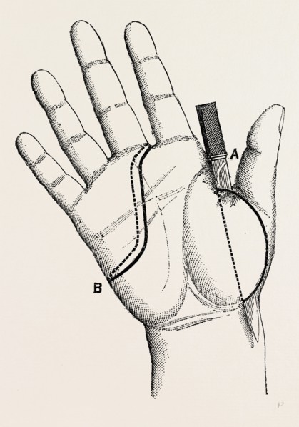 disartieulation of the thumb, medical equipment, surgical instrument, history of medicine