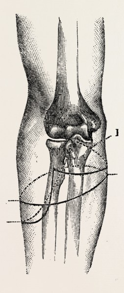 disarticulation, medical equipment, surgical instrument, history of medicine