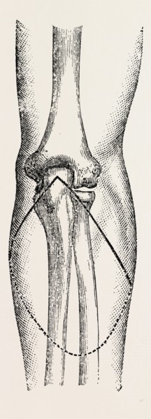 disarticu- ikemorritage.Ã¢â‚¬â€ùin addition to muscular, medical equipment, surgical instrument,
