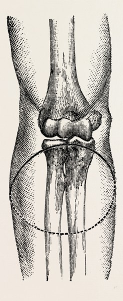 disarticulation, medical equipment, surgical instrument, history of medicine