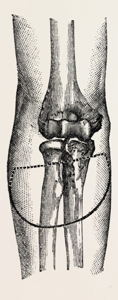 disarticulation, medical equipment, surgical instrument, history of medicine