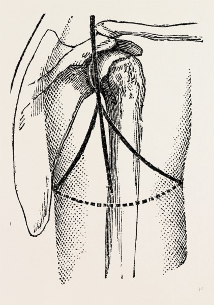 disaetictjlation at the posterior part of the oval, medical equipment, surgical instrument, history