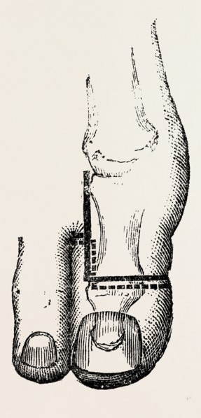 disarticulation, medical equipment, surgical instrument, history of medicine