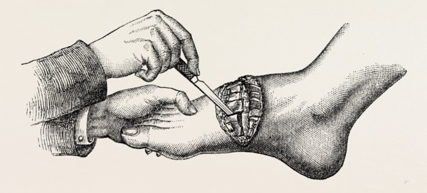 the coup de maitre in lisfrancis amputation, first step, medical equipment, surgical instrument,