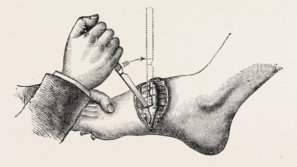 the coup de maitre in lisfrancis amputation, second step, medical equipment, surgical instrument,