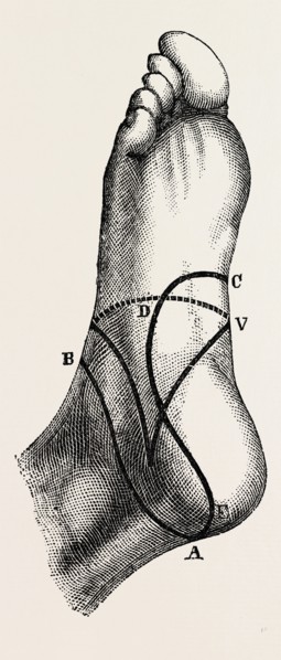 inner and outer sides of the right foot, to show the incisions, medical equipment, surgical